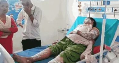 रुद्रपुर : गैस रिसाव से सिलेंडर में लगी आग, तीन महिलाएं समेत चार लोग झुलसे